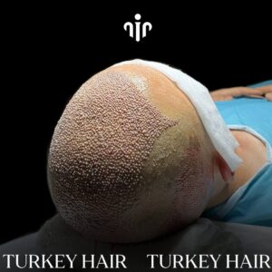 Hair Pros Turkey